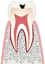 エナメル質の虫歯