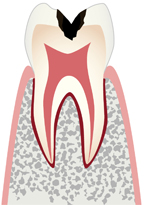 象牙質の虫歯