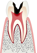 神経まで達した虫歯